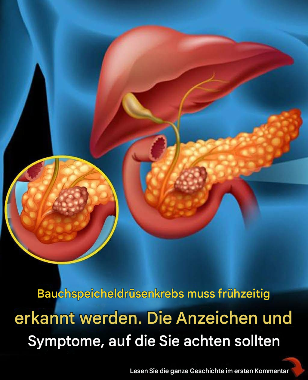 Anzeichen von Bauchspeicheldrüsenkrebs, die Sie niemals ignorieren sollten Weiterlesen