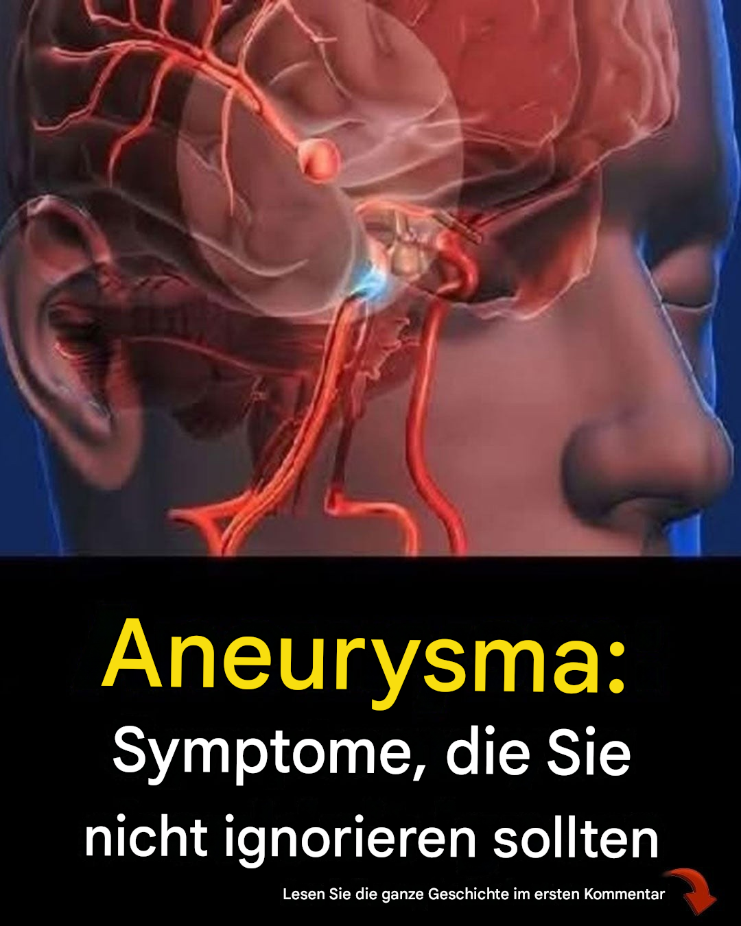 12 Frühwarnzeichen eines Aneurysmas, die Sie nicht ignorieren sollten