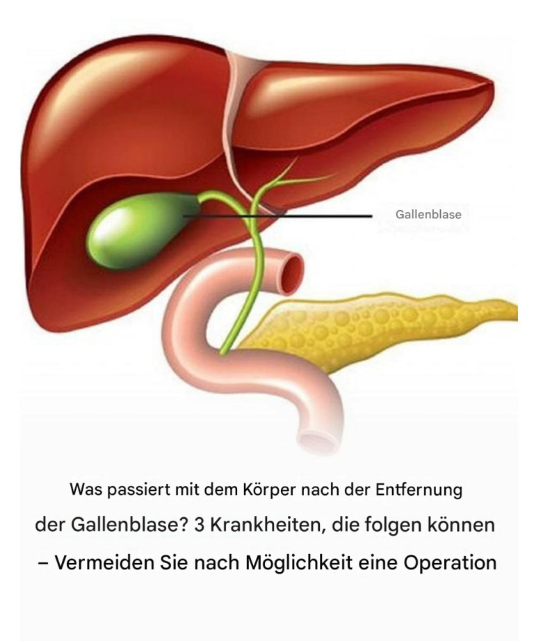 Was passiert nach einer Gallenblasenentfernung mit dem Körper? 3 mögliche Folgeerkrankungen – Operation möglichst vermeiden