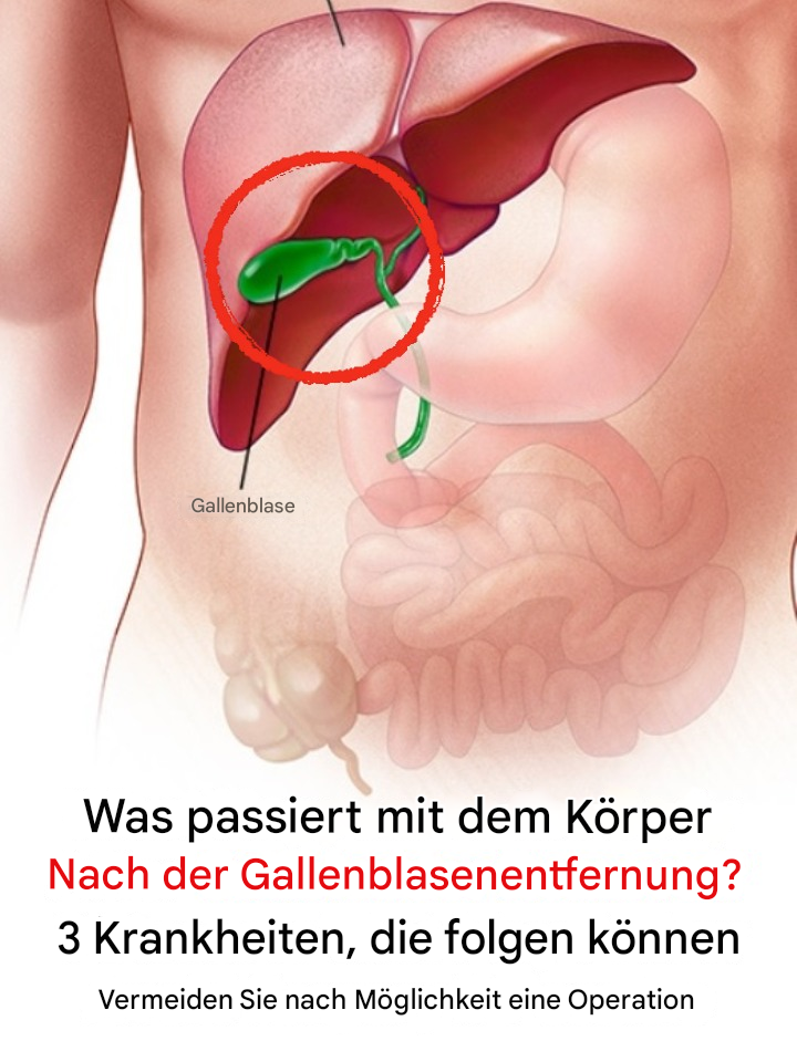 Was passiert nach einer Gallenblasenentfernung mit dem Körper? 3 mögliche Folgeerkrankungen