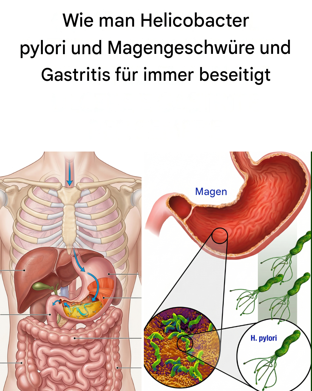Wie man Helicobacter pylori eliminiert und Gastritis sowie Magengeschwüre behandelt